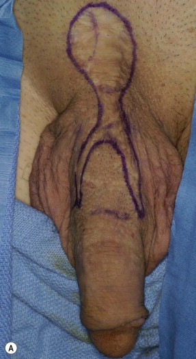 vy-plasty-of-penis-complication.jpg